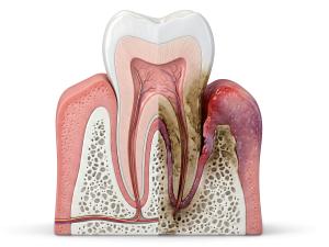 Tooth Normal Vs Decay PowerPoint clipart graphic preview.