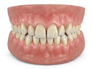 Yellowed Tooth Enamel PowerPoint clipart graphic preview.